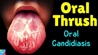 Oral Thrush | Oral Candidiasis – Symptoms, Causes, Diagnosis, Treatment, Complications