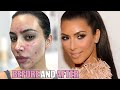 Kim Kardashian: CRAZY Skin Procedures (2021) - Vampire Facials and Lasers