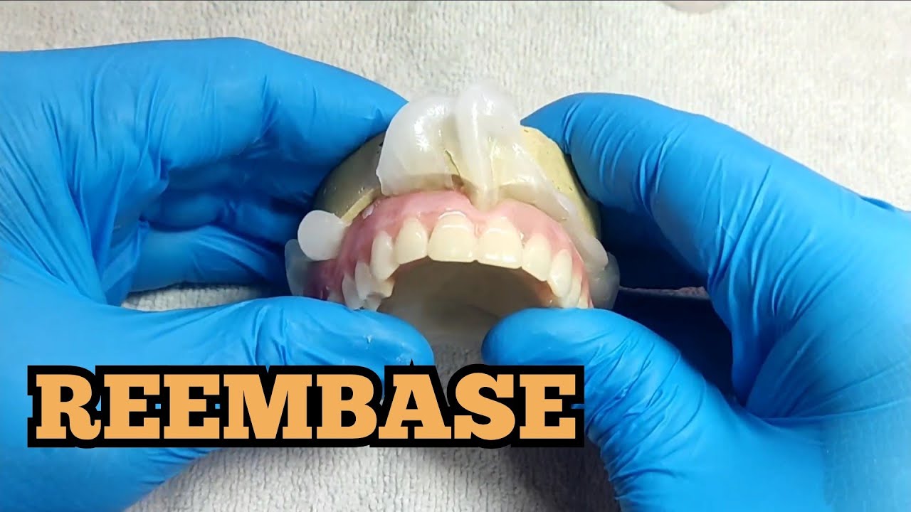 Como fazer um reembase de uma dentadura