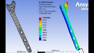 3D CAD of Locking compression Plate for femur tibia bone fracture: Solidwork ANSYS: Injury Biomech