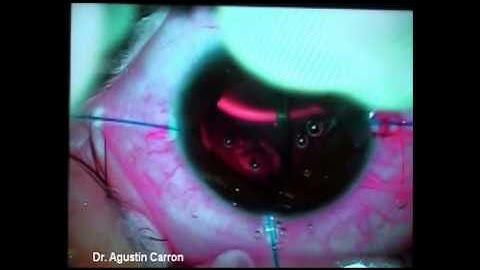 Cataract surgery using iris hooks in a patient with pupillary membrane due tu uveitis