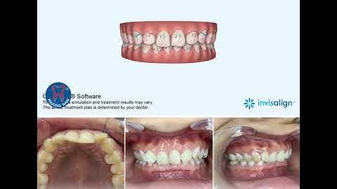 CLINCHECK XEM TRƯỚC KẾT QUẢ NIỀNG RĂNG INVISALIGN
