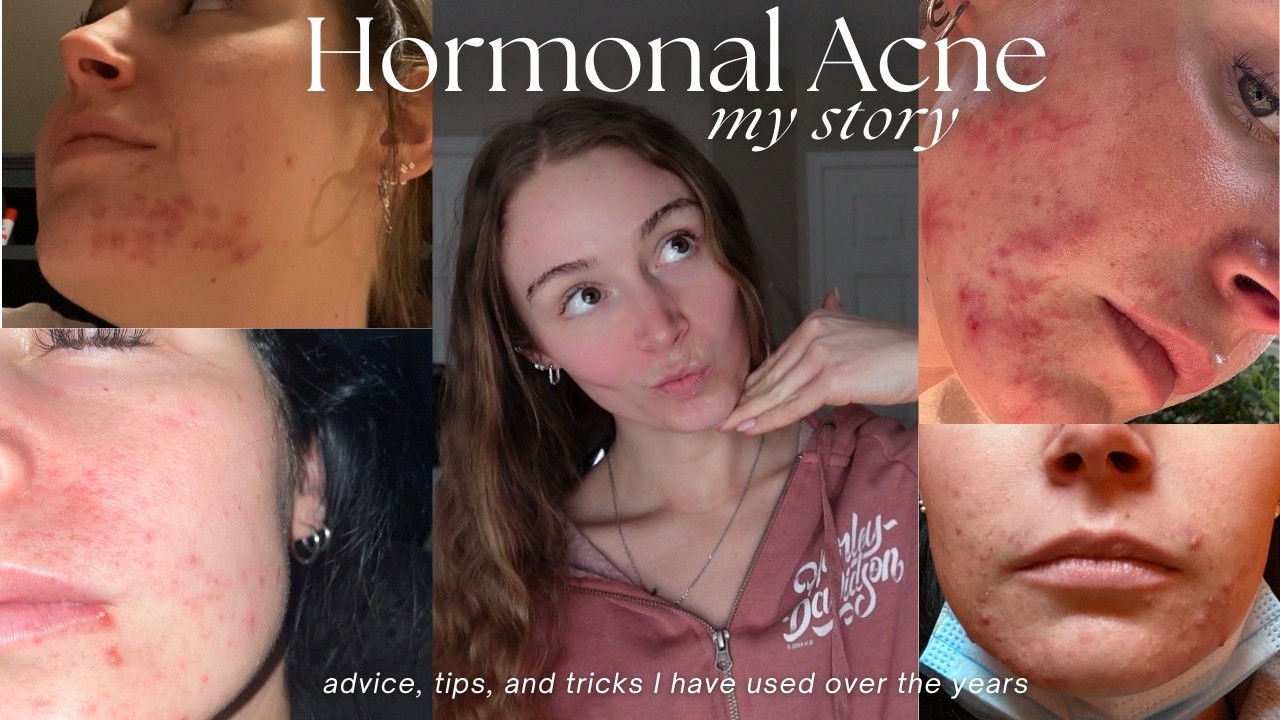 Hormonal Acne | My story! Advice, Tips, and a brand that works for me!