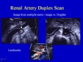 Renal Artery Duplex Scan