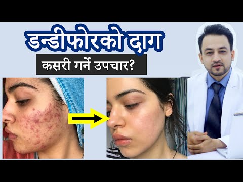 डण्डीफोरको दागको उपचार कसरी गर्ने । dandifor ko daag kasari  hataune । Treatment of acne scars