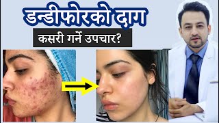 डण्डीफोरको दागको उपचार कसरी गर्ने । dandifor ko daag kasari  hataune । Treatment of acne scars
