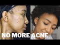 How to Get Rid of Acne Forever | My Acne Journey | how I Do Things | Kopano Shimange