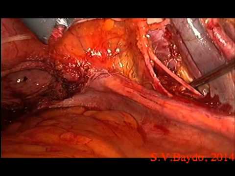 Laparoscopic Hysterectomy With Pelvic LND 40 Min Operation