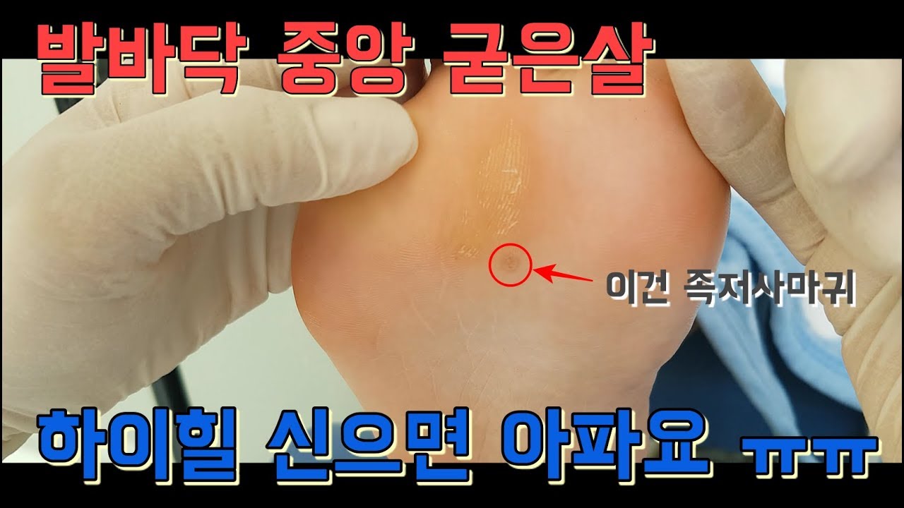 하이힐을 신어서 생긴 발바닥 가운데 굳은살 - 제거 합니다. #발바닥굳은살 #발바닥굳은살제거
