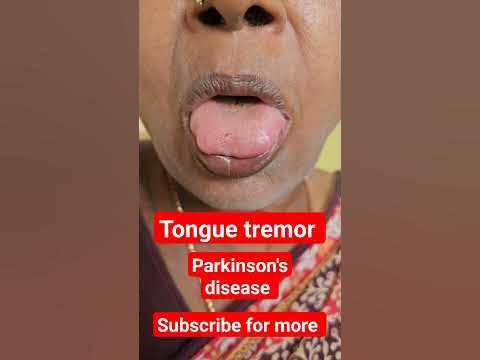 Tongue Tremor #neurology #medicine - YouTube