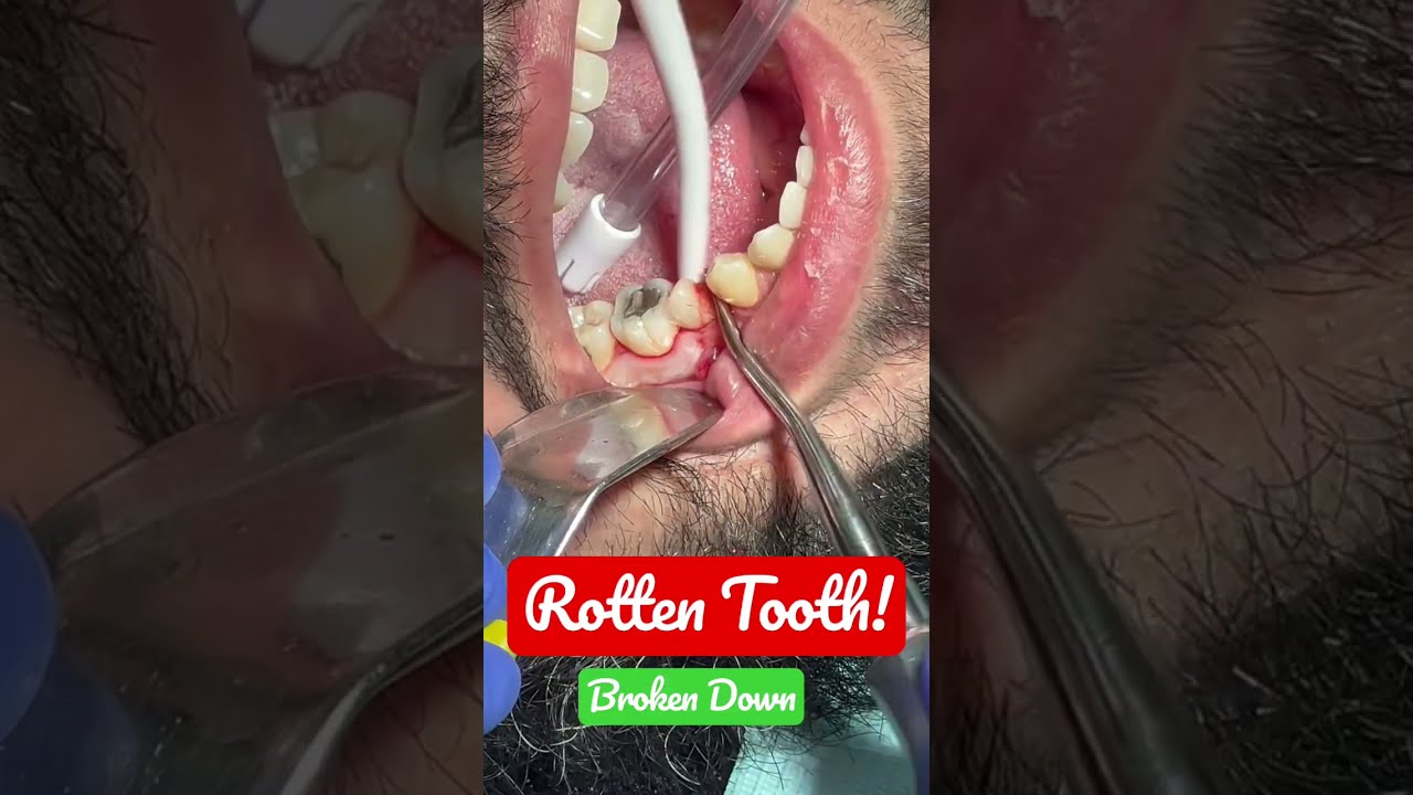 Broken Tooth Extraction