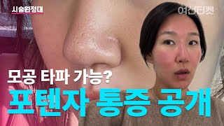 모공 때문에 고민이었는데… 포텐자 600샷 후기 (시술 직후 리얼 상태 공개)