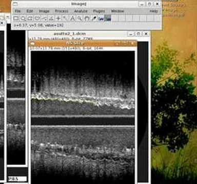 Coronary Segmentation IVUS ImageJ Plugin Daniel Lélis Baggio