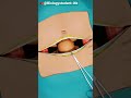 C Section (Cesarean Delivery) Surgery - 3D Animation #ritiksarojkachhidih #ytshort