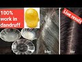 how to remove dandruff in one wash /how to get rid of dandruff in one wash/scalp dandruff removal