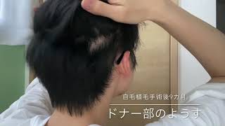 自毛植毛の基礎知識7選 クリニックを選ぶ前にまずは真実を知っておこう 自毛植毛でおでこが狭くなり前髪が増えたブログ