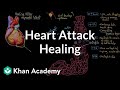 Heart Healing After Myocardial Infarction