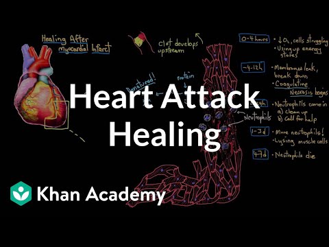 Video: Treatment After Myocardial Infarction