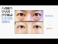 [JPN/CHI sub] 프라미스 눈성형 무보정 전후 모음 😎 │ 자연유착 절개 애교필러 눈밑지방재배치