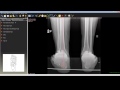 Orthopedic My Pearls & Tips - Ankle Varus deformity ...