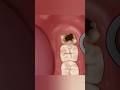 👄🦷 ASMR Satisfying Wisdom Tooth Removal | Relaxing Dental Care Animation 😌✨#animation