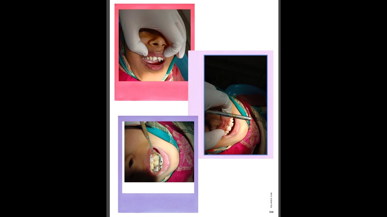 Light cure composite filling procedure tooth colour filling in front