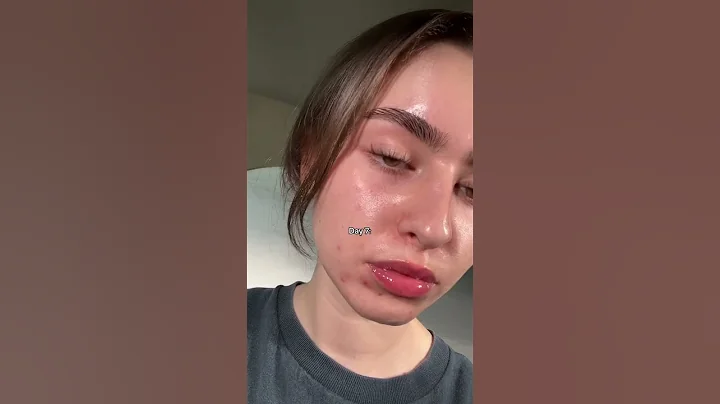 The tretinoin purge better be worth it 🙃 #tretinoin #shorts #dani