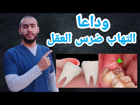 التهاب ضرس العقل وعلاجه اعراض التهاب ضرس العقل
