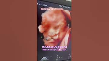 Hình ảnh siêu âm 5D em bé sức môi hở hàm ếch.