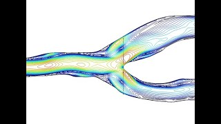 Velocity Streamline in Carotid artery-Comsol