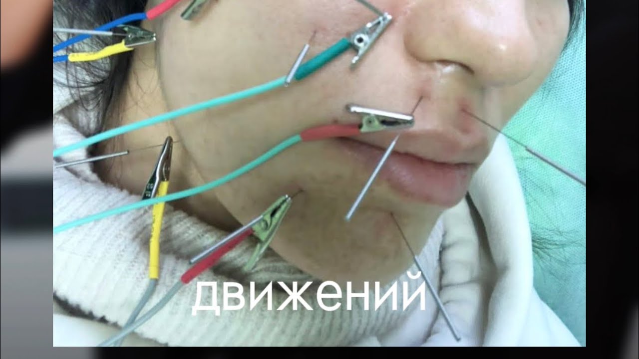 Паралич Белла- история нашего врача! - YouTube