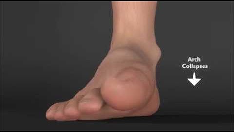 Sole Supports: A 2 Minute MASS Posture Theory Primer