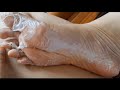 Satisfying Foot Peeling || Calluses Removal