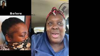 Fort Lauderdale Hair Transplant Clinic | Experts in Hair Transplantation for Black Women