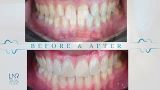 Digital Smile Makeover with 6 E-max Veneers | Natural and Minimal Approach