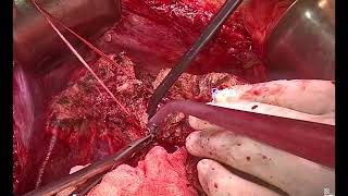 Modulated partial associating liver partition and portal vein ligation... Part 2