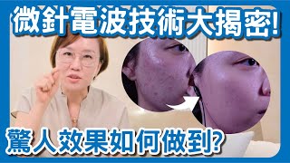 討人厭的嘴邊肉和痘疤！？試試看墨菲斯微針電波！