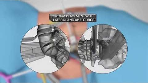 NuVasive Lateral ALIF Animation