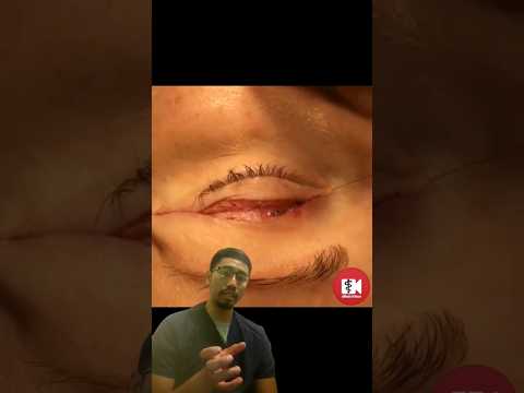Video: Bagaimana cara memijat kelopak mata bawah setelah blepharoplasty?
