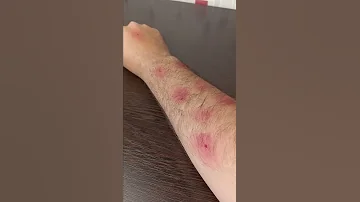 Как избавиться от укусов комаров. Полезный лайфхак.