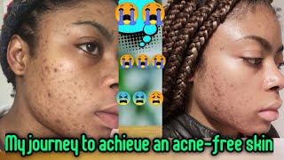 GOING ON ACCUTANE(Isotretinoin) IN CHINA | with pictures