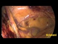 Laparoscopic inguinal groin hernia repair surgery tapp approach