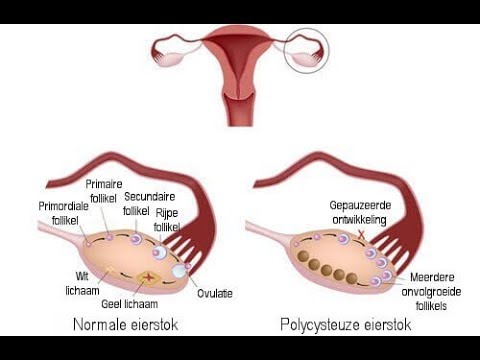 Video: 17 Huismiddeltjes Om PCOS + -preventietips Te Behandelen