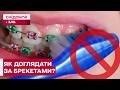Які дозволи та заборони існують при носінні брекетів? Що треба знати?