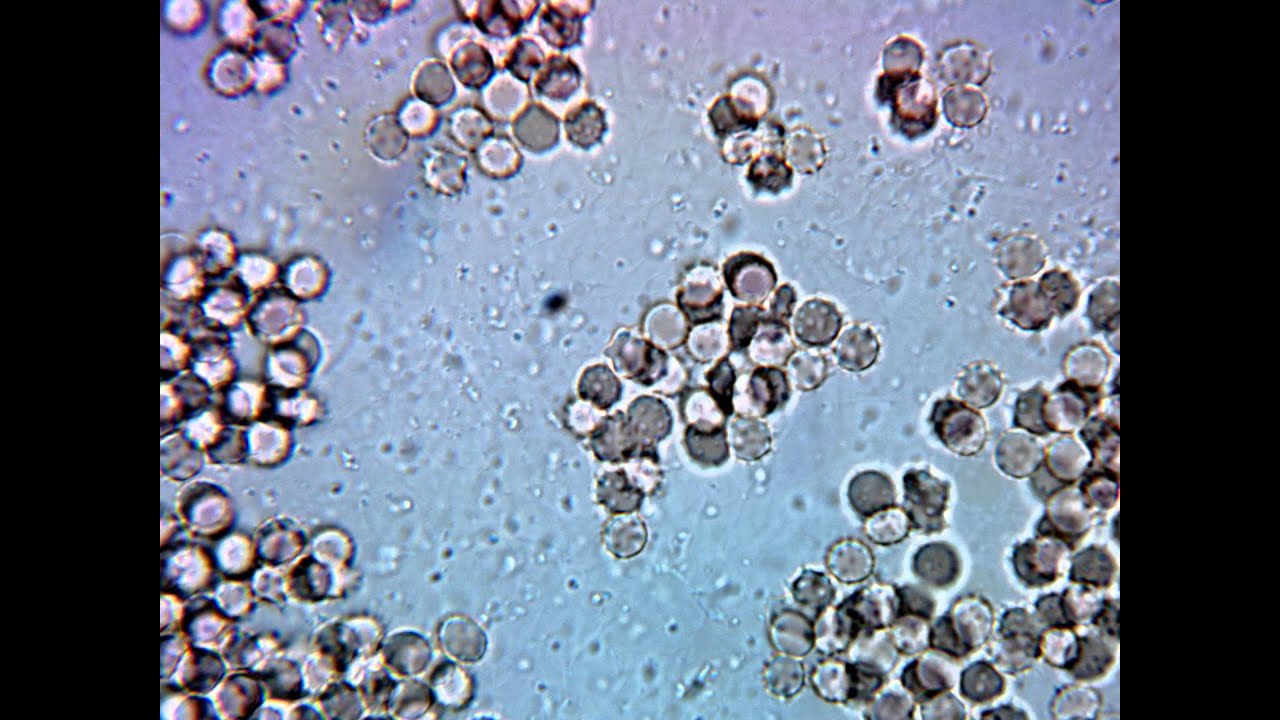 Lyme diseased blood with blebs & cysts YouTube