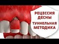 Оголились корни зубов? Лечение рецессии десны туннельной методикой | Дентал ТВ