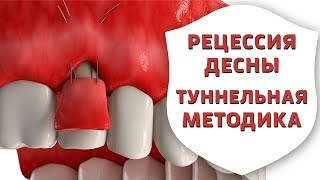 Оголились корни зубов? Лечение рецессии десны туннельной методикой | Дентал ТВ