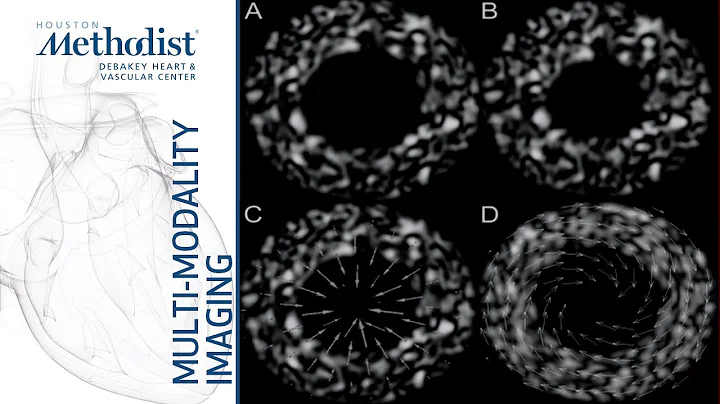 Echo Assessment of LV Function: EF, Strain, Cardio-oncology (Miguel Quiñones, MD ) October 15, 2019