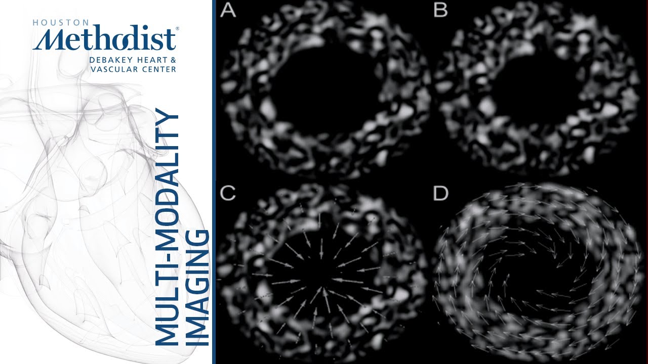 Echo Assessment of LV Function: EF, Strain, Cardio-oncology (Miguel Quiñones, MD ) October 15, 2019