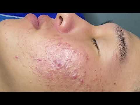 Video Inflammatory Acne Hematoma | Mụn Viêm Tụ Máu Dưới Da -... - youtube